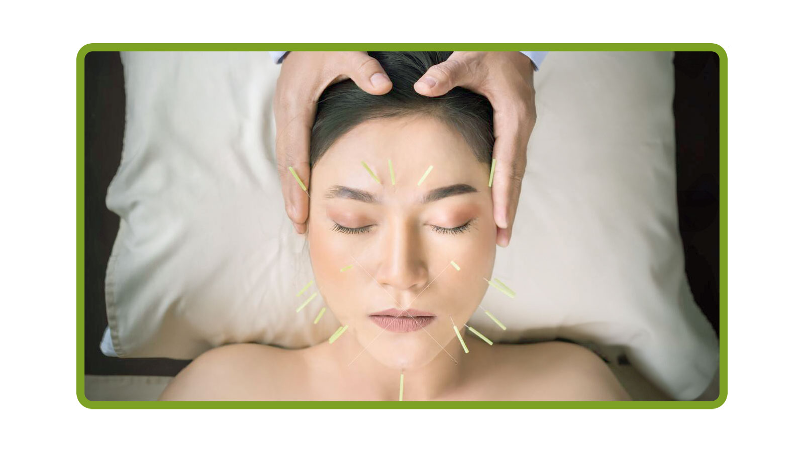 Acupuncture for the Athlete Image